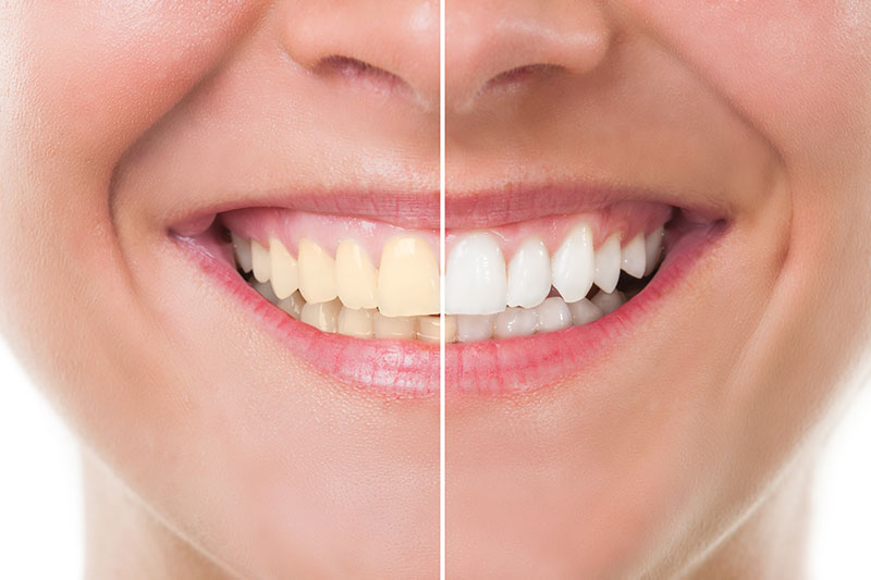 Teeth Whitening in Lake Elsinore